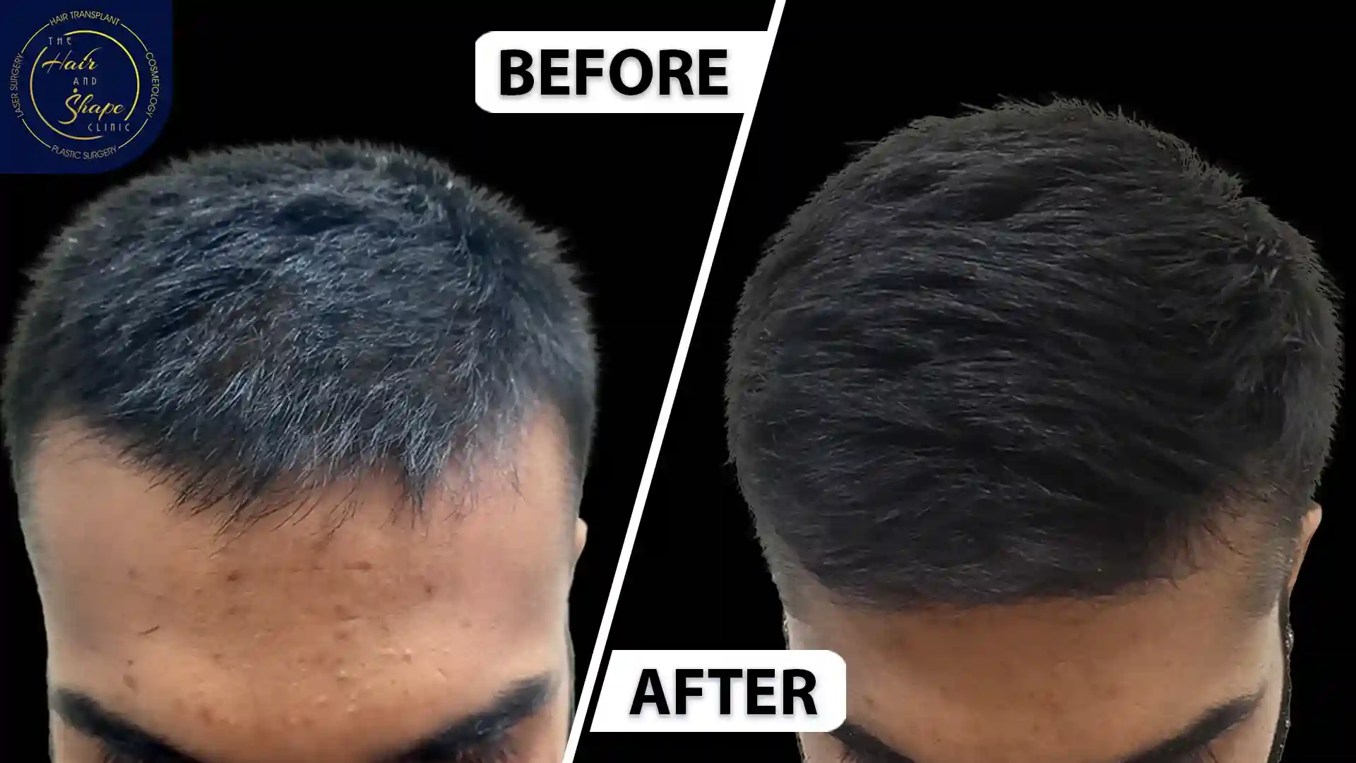 PRP Treatment result7